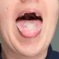 Помощ при бели петна по езика