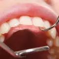 Революционен метод ще кара развалените зъби да се самовъзстановяват