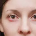 Какви са причините за появата на ечемик на окото?