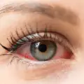 Алергия на очите: Какво трябва да знаем?