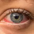 Най-често срещаните очни алергии