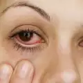 Кръвоизлив в окото - причини и лечение