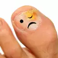 Причини и лечение на гъбички по ноктите