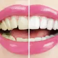 Жълти зъби - причини и съвети за избелване