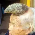 Ужас! Гигантски рог расте на главата на китайска баба