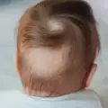 Причини за загуба на коса при децата