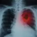 Всичко, което трябва да знаете за рак на белия дроб