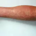 Червени петна по кожата