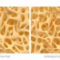 Остеопороза - защо се получава и как да се предпазим?