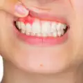 Как да възстановим венците си