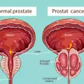 9 съвета за профилактика срещу рак на простатата