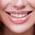 Как да си избелим зъбите с джинджифил?