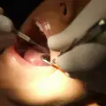 Рушене на зъбите
