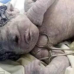 Newborn with a Single Eye Proves That Cyclopes Did Exist