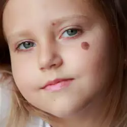 Birthmarks are Related to a Past Life