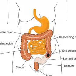 Липсата на хормони води до рак на дебелото черво?