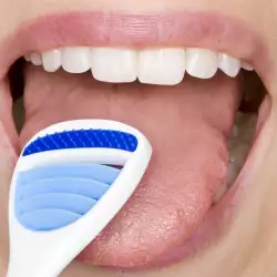 Как да премахнем белите налепи по езика?