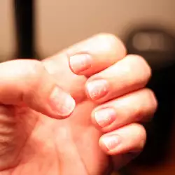Каква е причината за чупливи нокти?