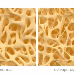 Остеопороза - защо се получава и как да се предпазим?
