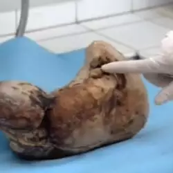 Възрастна китайка роди каменно бебе