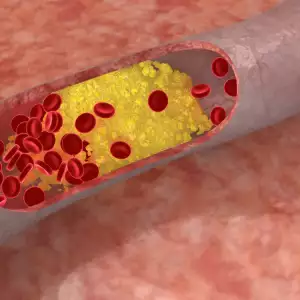 Запушване на артериите при атеросклероза
