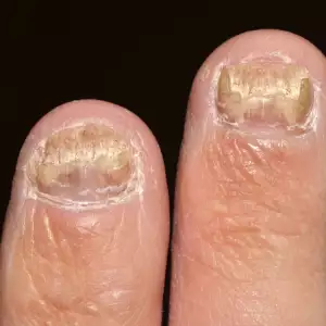 Гъбички по ноктите