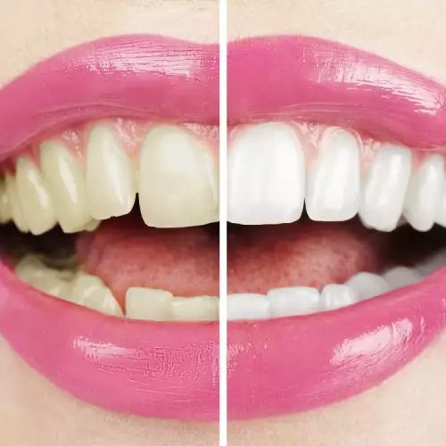 Откажи се от тези вредни навици, ако искаш по-бели зъби!