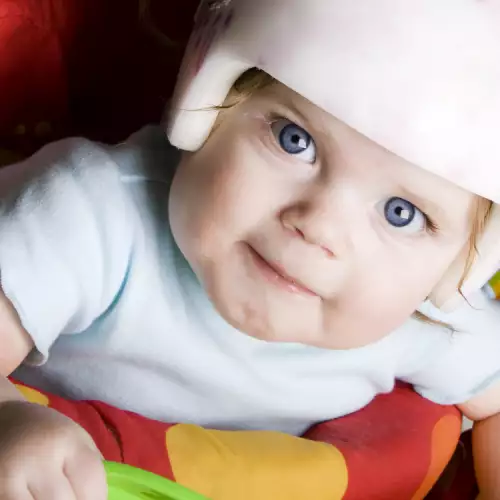 Плагиоцефалия - плоска глава при бебе