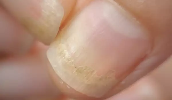 Гъбични инфекции на ноктите