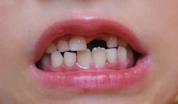 Падащи зъби