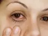 Как да се предпазим от очни възпаления?